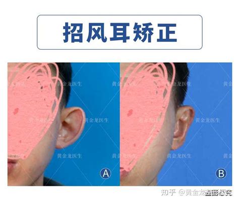 男孩子长招风耳好不好？为什么男怕招风耳？_男孩子长招风耳好看吗,第3张